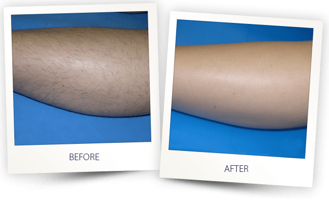 Laser Hair Removal Fort Lauderdale