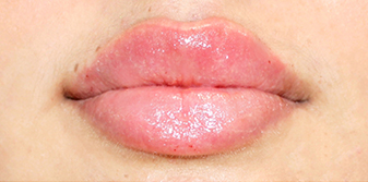 lips after 1