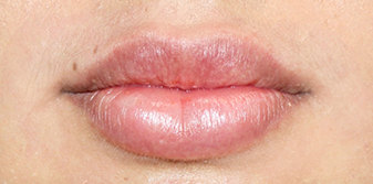 lips before 1